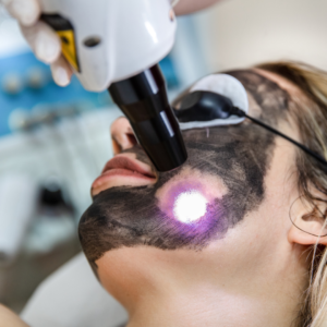 Carbon Toning Laser Treatment