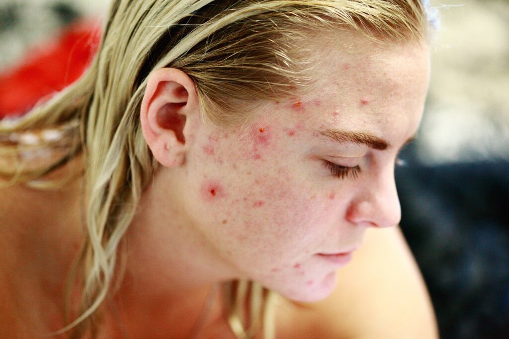 Acne and Pimples Treatmentt
