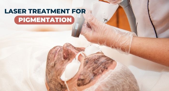 laser treatment for pigmentation