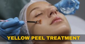 What is Yellow Peel Treatment | Benefits, Procedure, Cost - Dr. Kasana