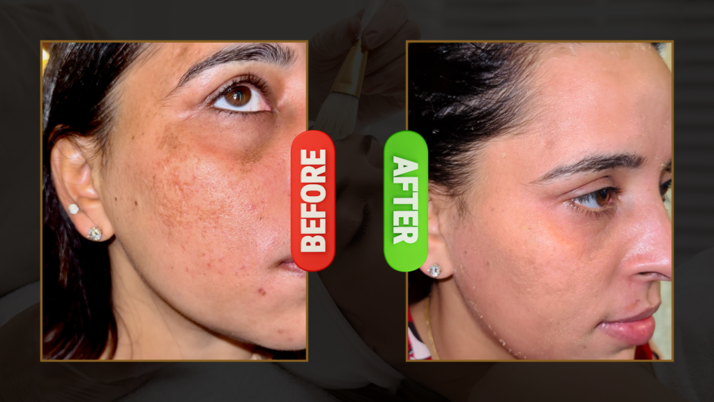 Advanced Treatment for Hyperpigmentation