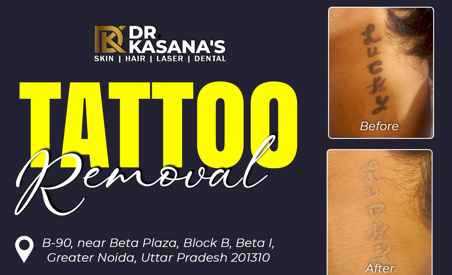 Before and After Tattoo Removal